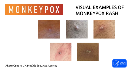 Photos showing different examples of monkeypox rash on skin.