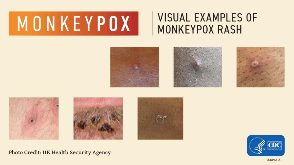 Visual examples of monkeypox rashes.